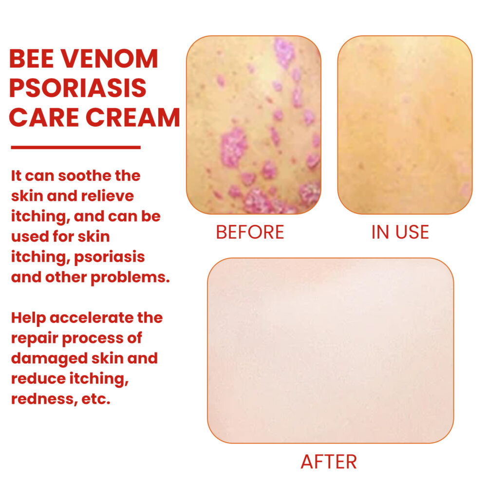 Bee-poison cowhide Moss Cream Relieves redness, itchiness and swelling skin Repair ointment #JL04-XIB05-A024-20-YE1 - Image 5