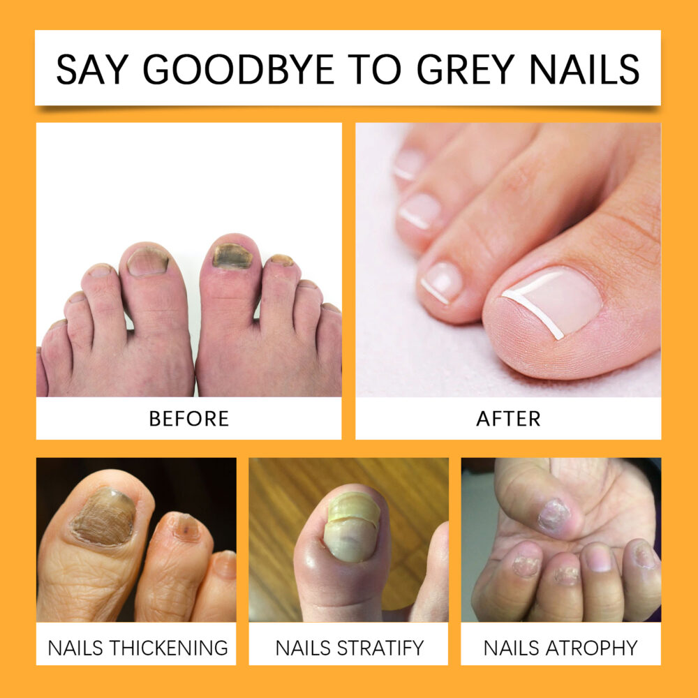 Bee Venom Gray Nail Care Solution Hand and Foot gray Nail cleaning, Repairing, softening and brightening nutritional care solution #JL04-XIB05-A038-15-YE1 - Image 16