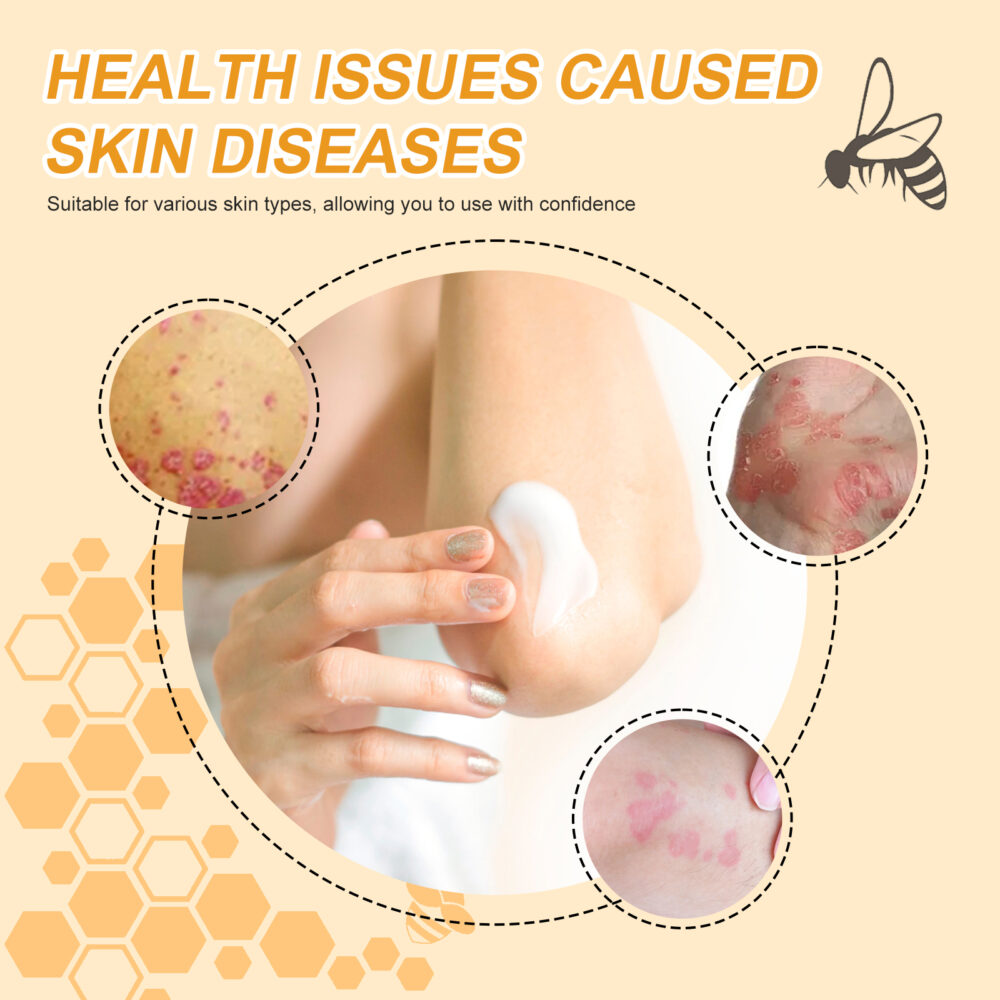 Bee Venom psoriasis Care Cream Relieves itchy, redness and moisturizing skin care cream #JL04-WYA06-A011-30-WH1 - Image 4