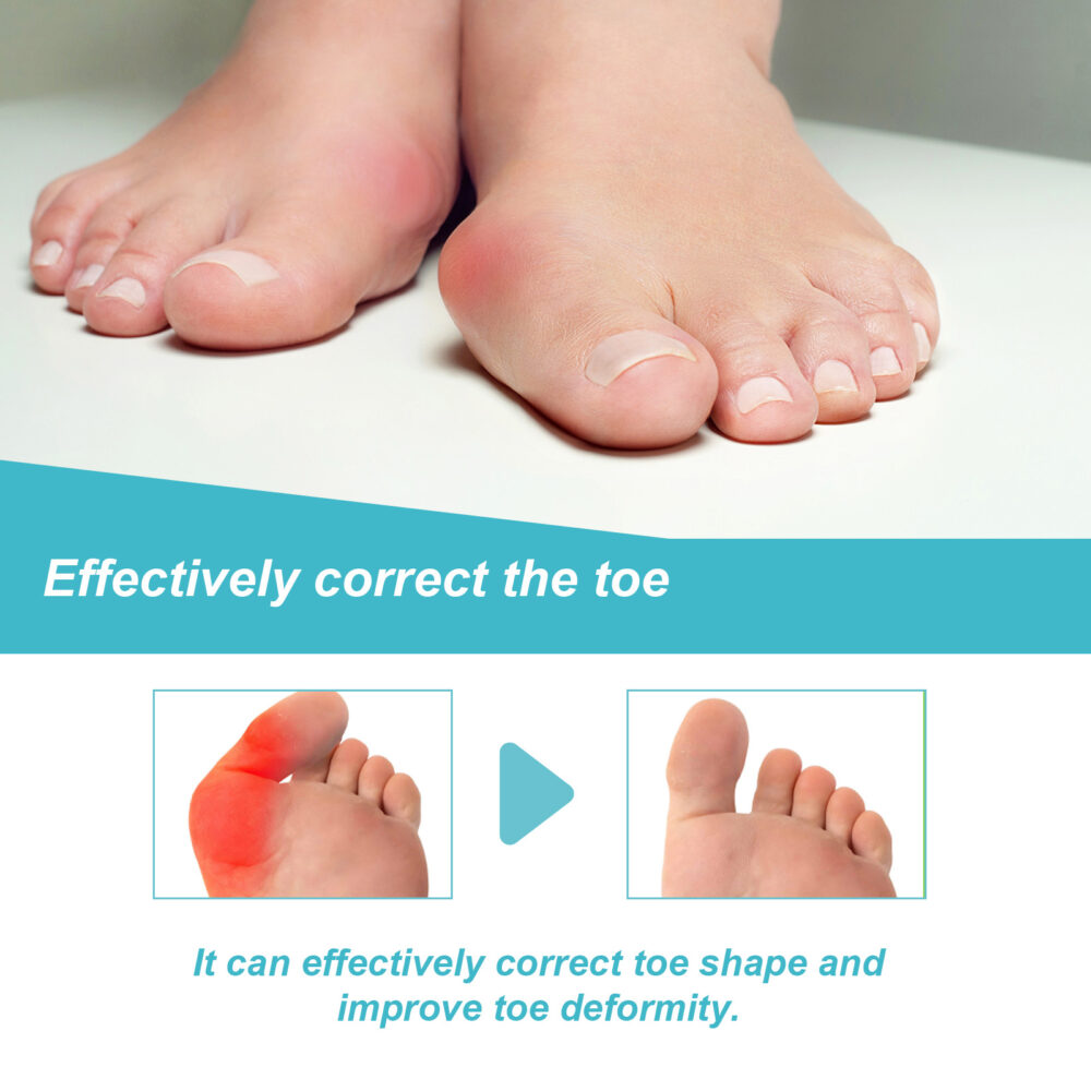 Corrective foot pads relieve pain and swelling of the big toe valgus joint Foot care Corrective foot pads #JL04-XIB05-A018-33-BU1 - Image 5