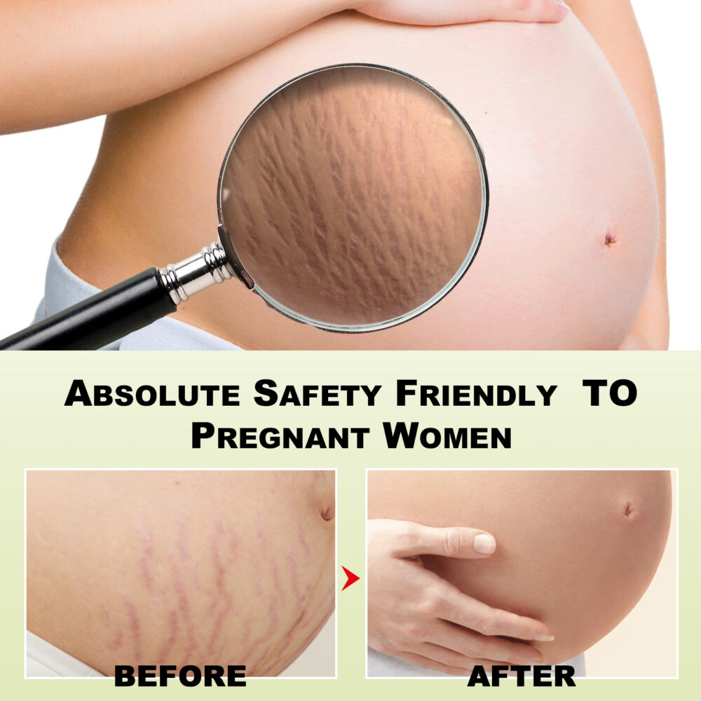 Scar Whitening Cream Moisturizes and smooths skin repair cream for surgical scars and pregnancy wounds #JL04-WYA06-A012-30-WH1 - Image 6