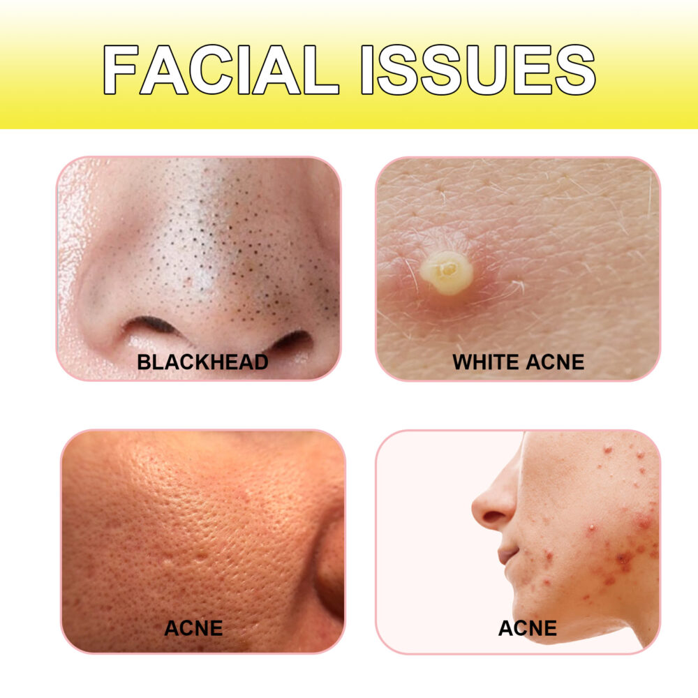 Acne Hydrocolloidal Patch Cleanses facial acne, closes mouth, removes blackheads and delicate skin patch #JL04-JAA05-A001-20-YE1 - Image 5