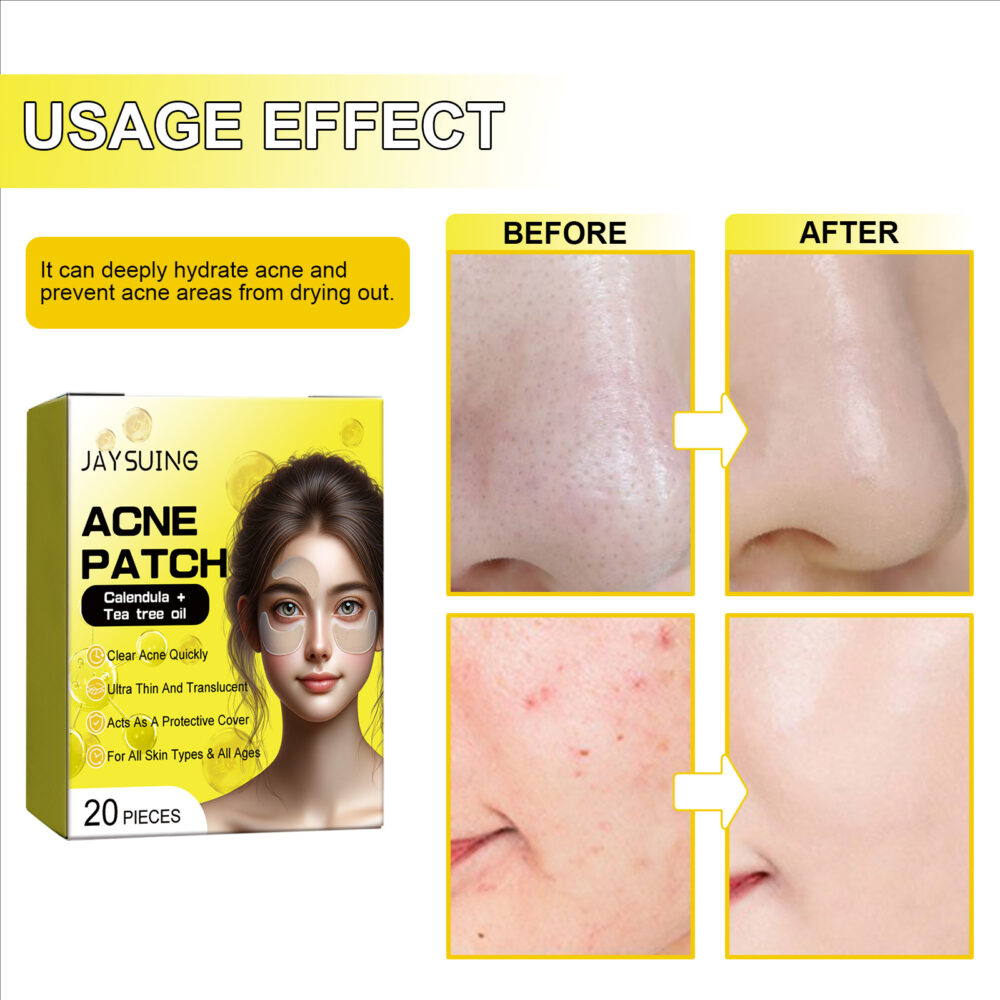 Acne Hydrocolloidal Patch Cleanses facial acne, closes mouth, removes blackheads and delicate skin patch #JL04-JAA05-A001-20-YE1 - Image 8